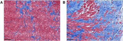 Histopathological insights into mitral valve prolapse-induced fibrosis